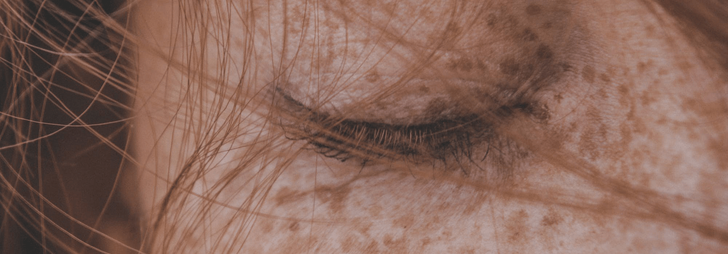 What is Bimatoprost and Why Should You Avoid It? - ForChics