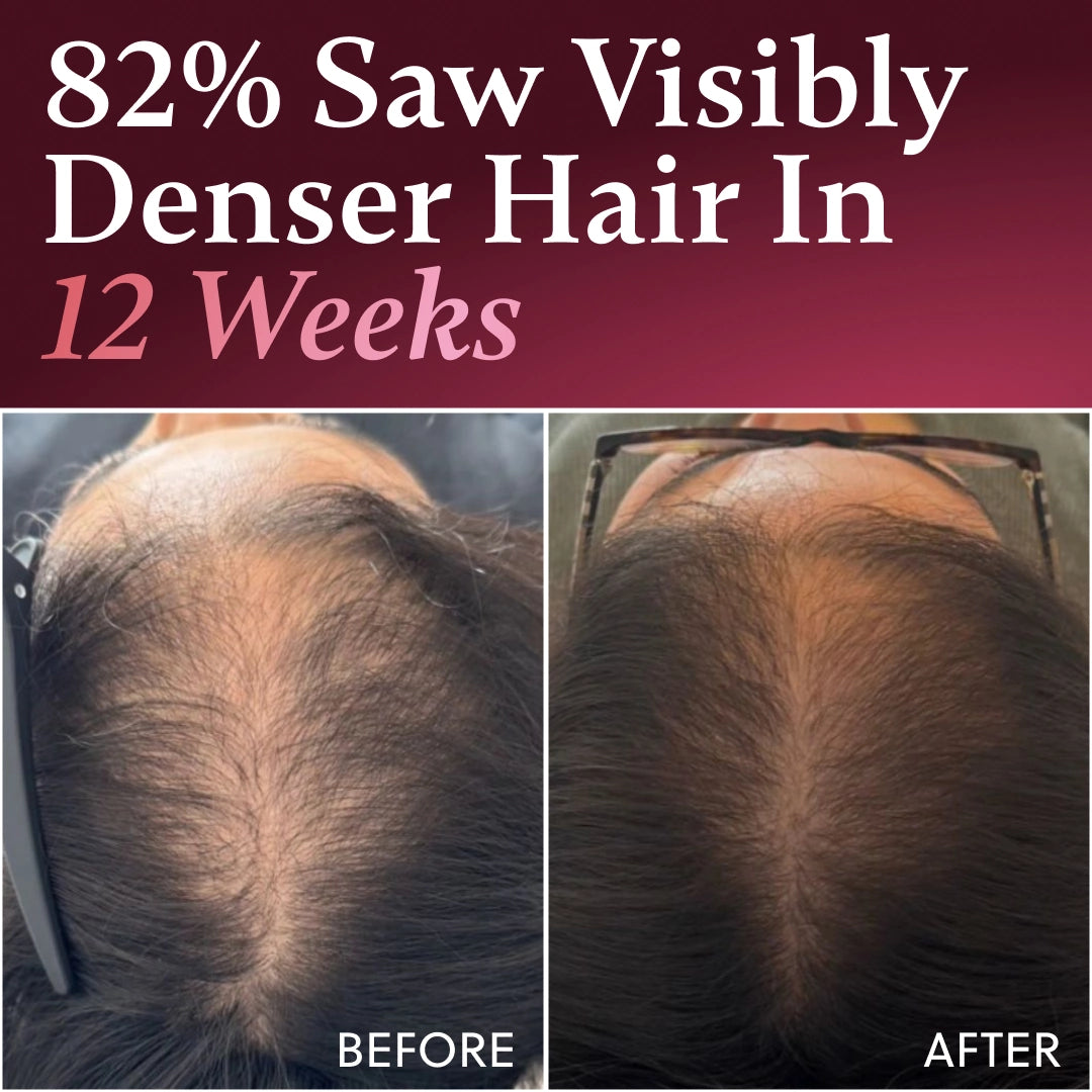 ForChics Hair Growth Density Refill